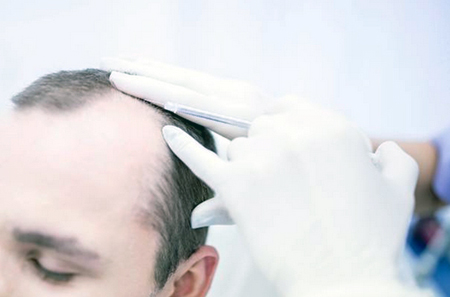 androgenic alopecia treatment