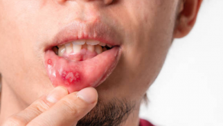 Treating herpes virus with Valacyclovir: what should you know?