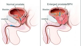 Prophylaxis, prevention, and treatment of benign prostatic hyperplasia