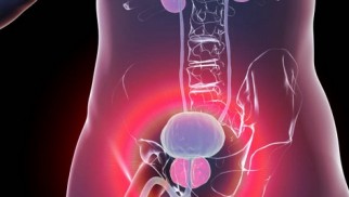 What you need to know about benign prostatic hyperplasia treatment