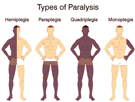 What is hemiplegia and how is it treated?