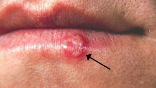 Do you know what herpes is and how is it treated?