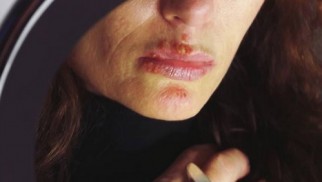 What is herpes and how is it treated?